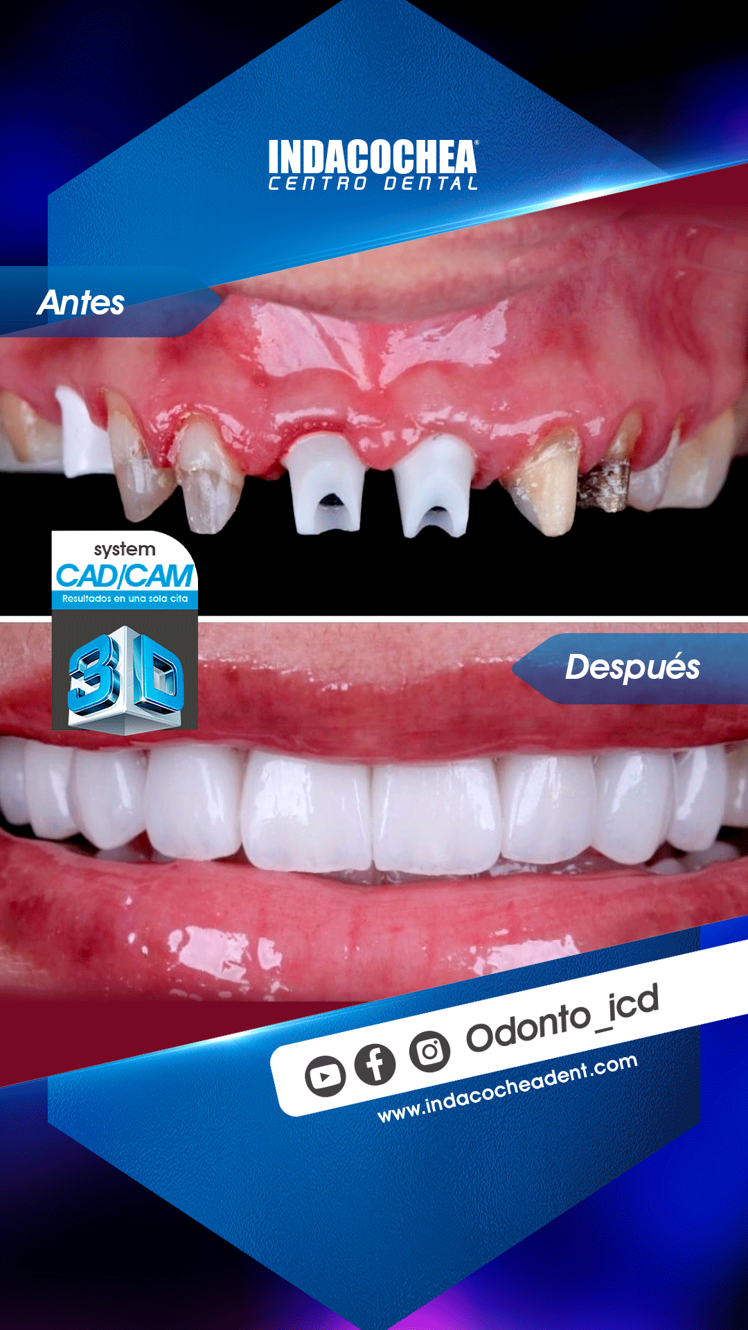 Antes y después de sonrisa gingival