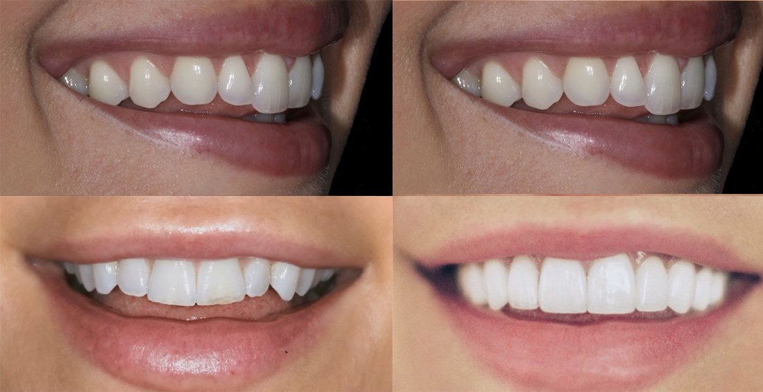 Antes y después del diseño de sonrisa en Indacochea